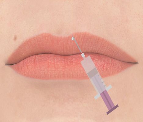 Augmentation des lèvres, injection d'acide hyaluronique : Est-ce la meilleure solution pour des lèvres charnues et pulpeuses ?