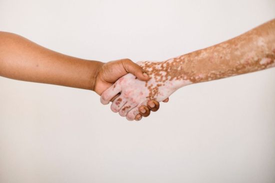 Une nouvelle technique pour traiter le vitiligo