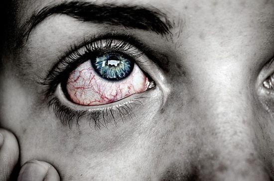 Épisclérite (inflammation du blanc de l'œil) : Causes qui nécessitent une consultation médicale