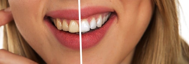 Comment le fluor aide-t-il à protéger vos dents contre la carie?